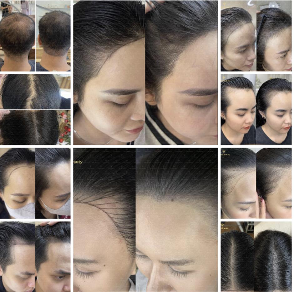 Bảng Giá Phun Xăm Tóc Tại Vian Beauty 18