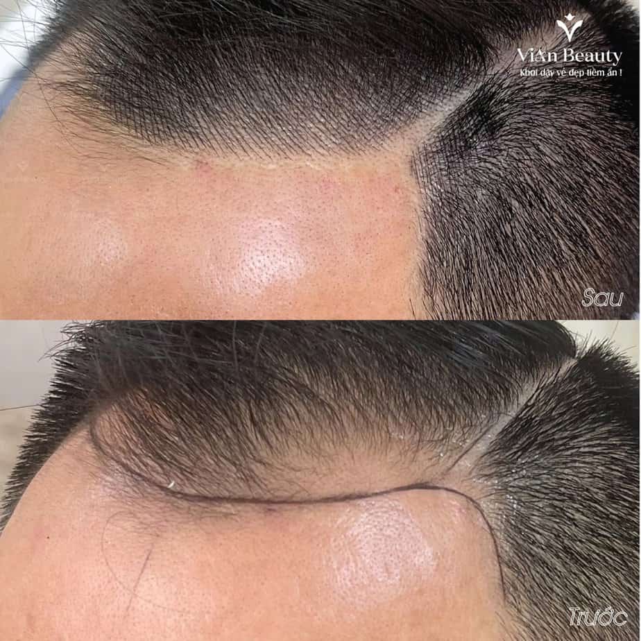 Bảng Giá Phun Xăm Tóc Tại Vian Beauty 23
