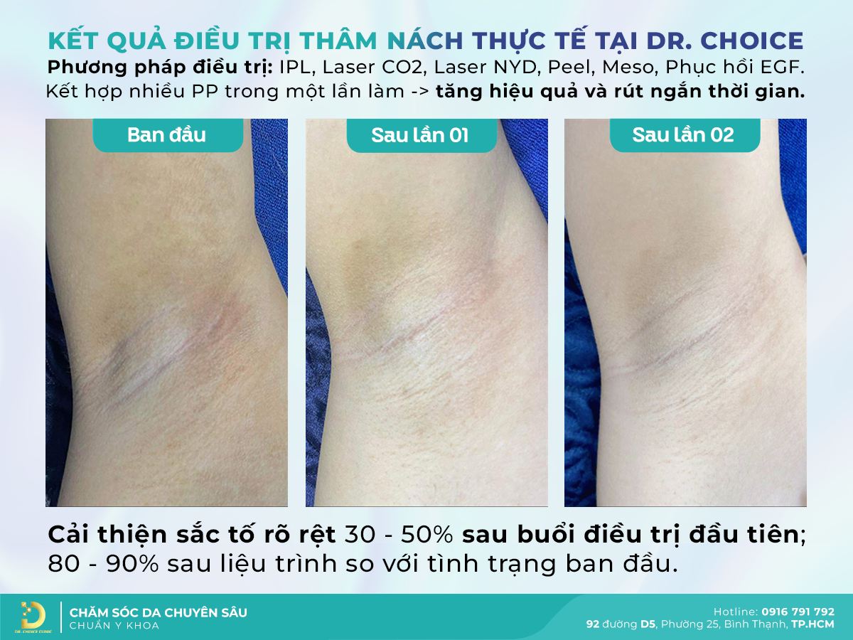 Trị Thâm Nách Hiệu Quả Tại Dr. Choice Clinic – Địa Chỉ Uy Tín HCM 18